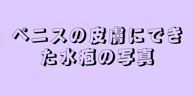 ペニスの皮膚にできた水疱の写真